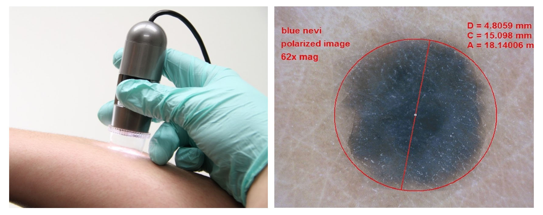 dermatoskopia cyfrowa.jpg